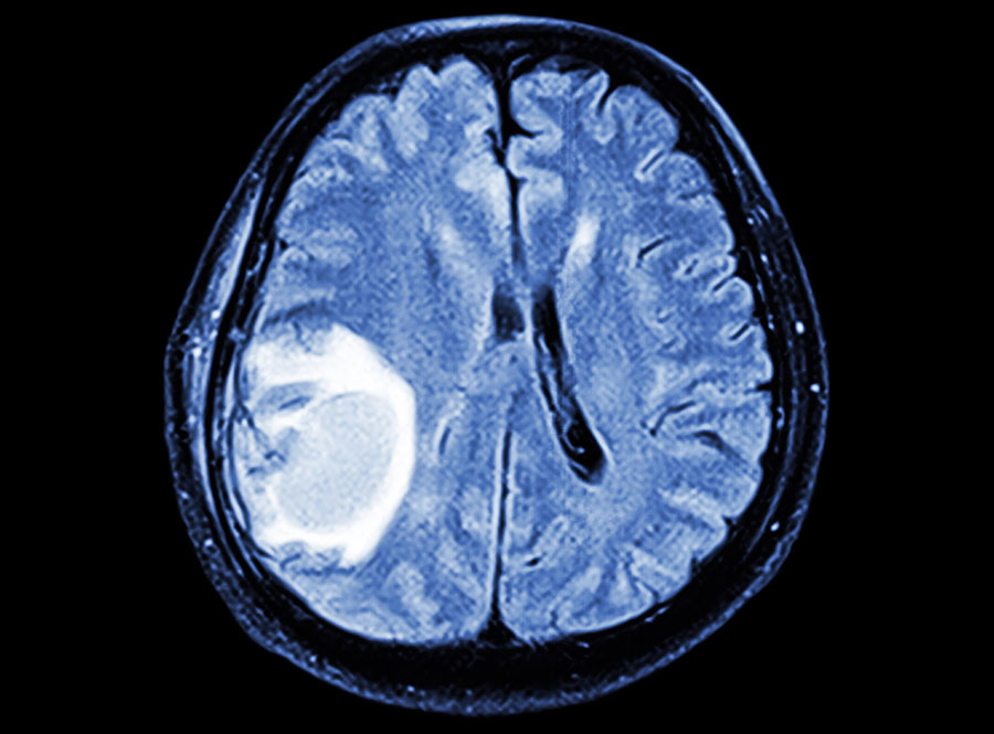 Astrocitomas Difusos IDH-mutados: o que são e como tratá-los?