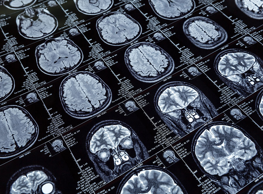 Oligodendrogliomas: o que são e como tratá-los?