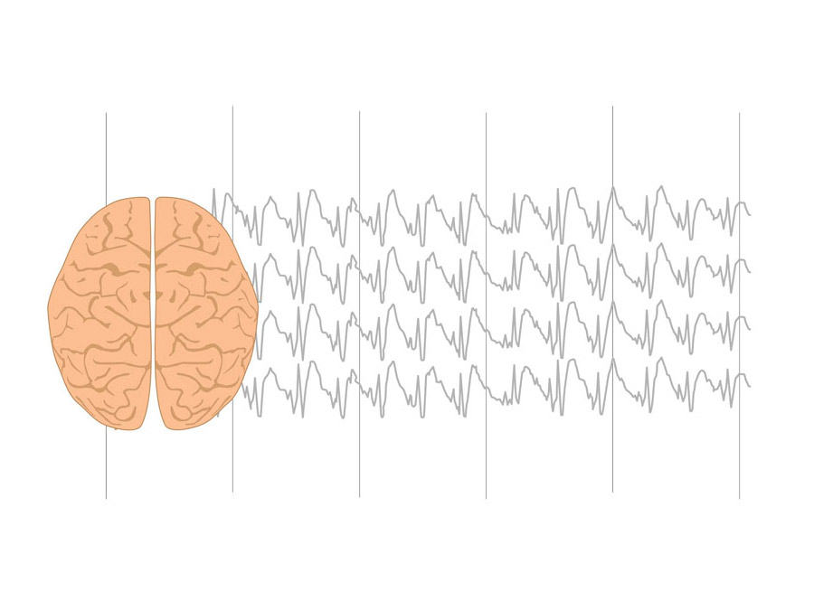 Gangliogliomas: sintomas, diagnóstico e opções de tratamento