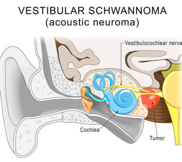 Schwannomas vestibulares 360x320