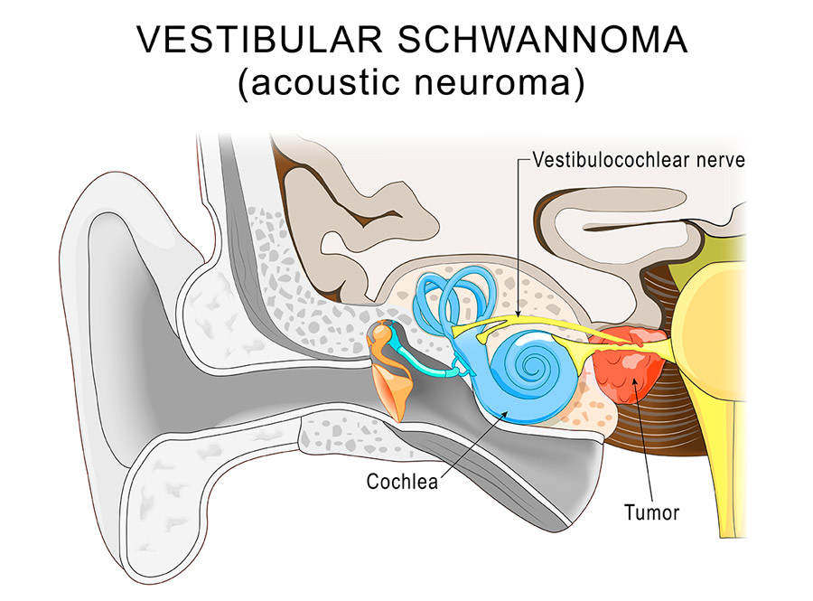 Schwannomas vestibulares
